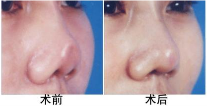 出现鼻缺损修复的方法有哪些