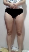 大腿吸脂+自体脂肪移植丰臀手术